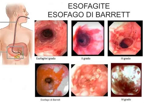 Schema che illustra il processo di biopsia ed analisi istologica per l'esofago di Barrett
