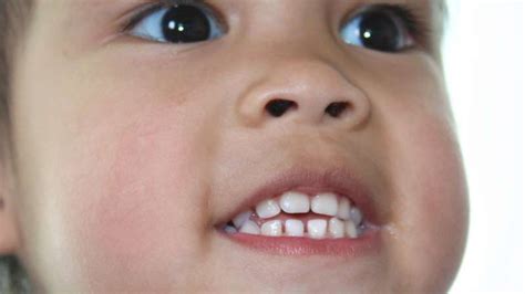 Immagine di un bambino con morso aperto anteriore