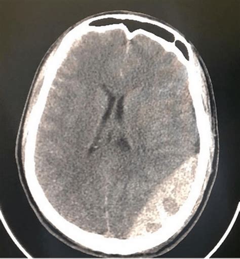 Tomografia computerizzata di un ematoma epidurale