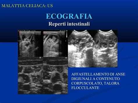 Ecografia anse intestinali fetali iperecogene