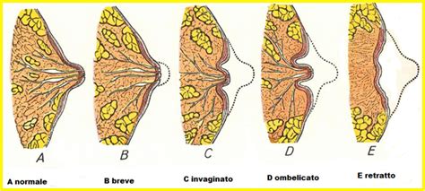 illustrazione di un capezzolo con una piccola bolla