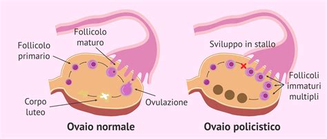 Schema della sindrome dell'ovaio policistico (PCOS)
