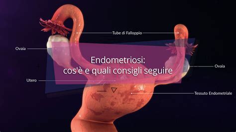 Immagine anatomica dell'utero con endometriosi