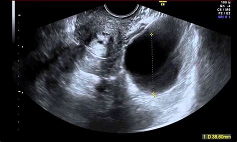 Ecografia pelvica che mostra l'utero