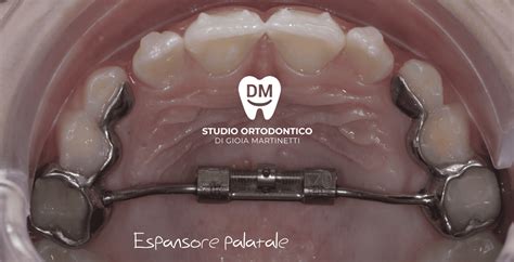 schema espansore palatale