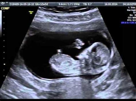 Feto di 12 settimane con dettagli anatomici