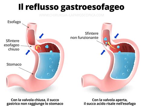 Diagramma che illustra le differenze tra reflusso gastro-esofageo e reflusso laringo-faringeo